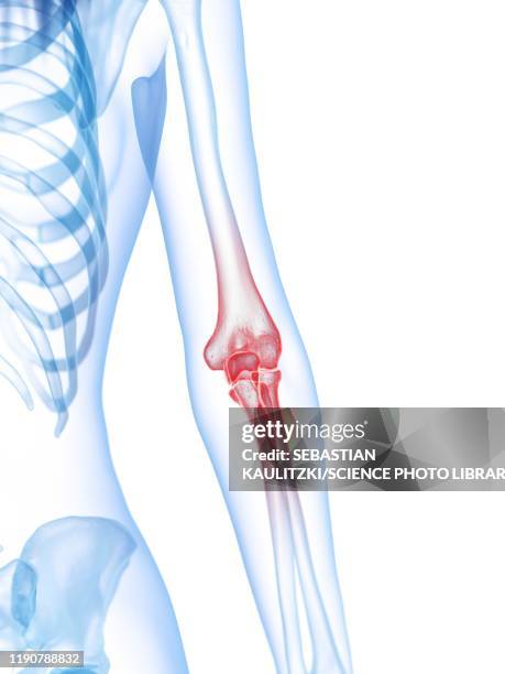 elbow pain, conceptual illustration - rheuma stock-grafiken, -clipart, -cartoons und -symbole