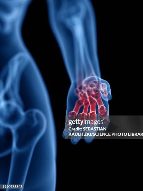 hand pain, conceptual illustration - metacarpal stock illustrations