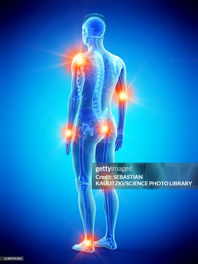 Joint pain, conceptual illustration