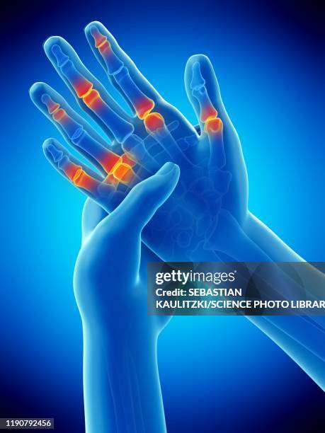 ilustrações de stock, clip art, desenhos animados e ícones de finger pain, conceptual illustration - arthritis