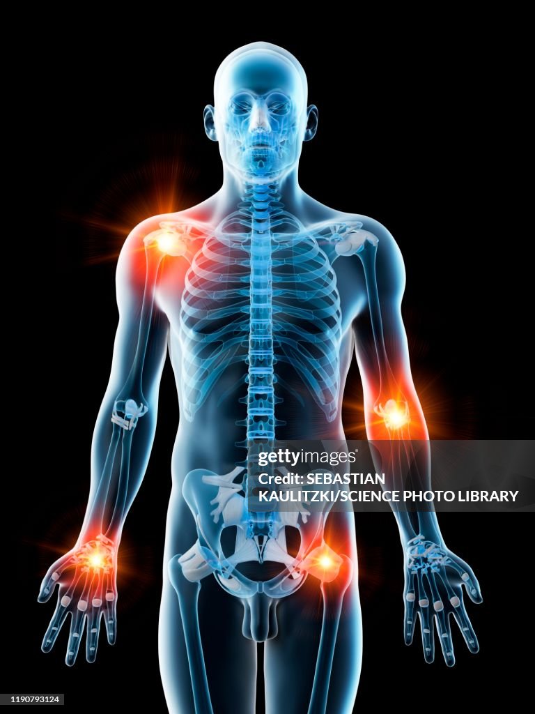 Joint pain, conceptual illustration