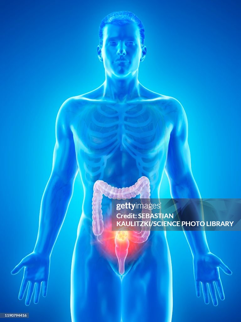 Colon cancer, conceptual illustration