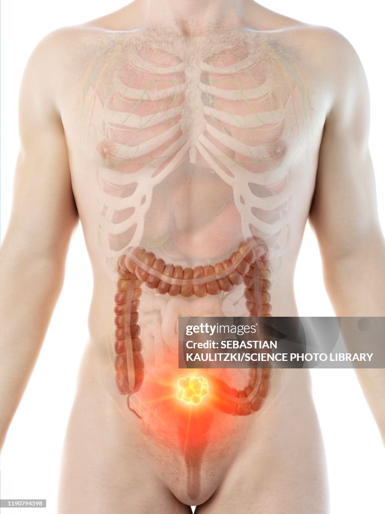 Colon cancer, conceptual illustration
