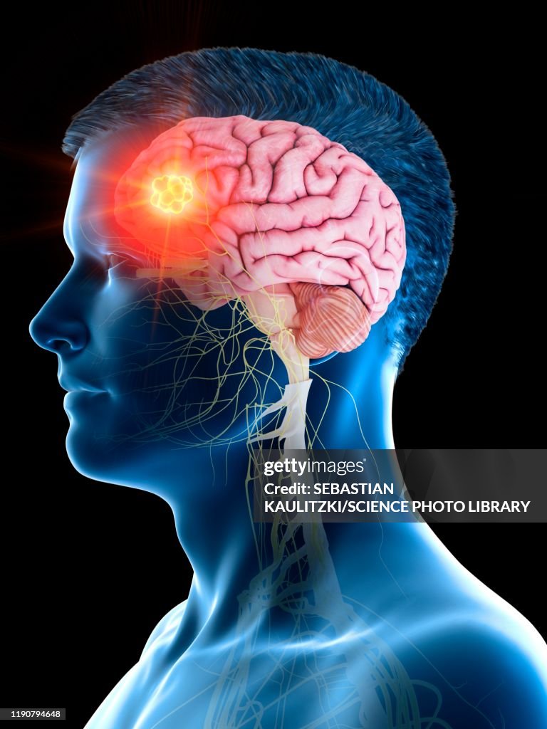 Brain tumour, conceptual illustration