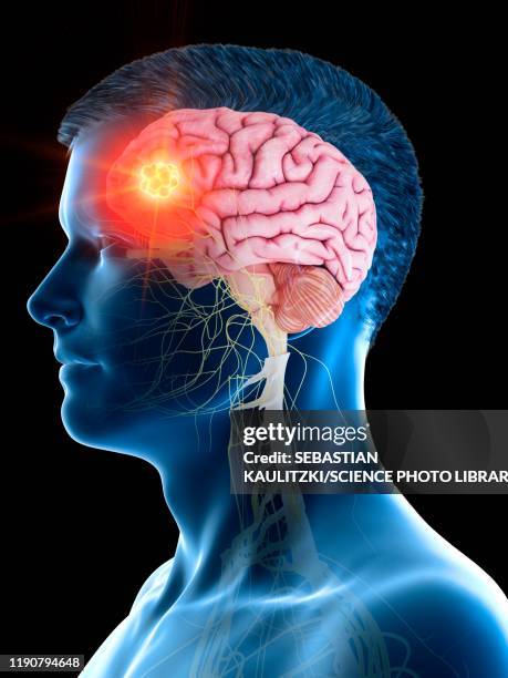 brain tumour, conceptual illustration - man black background stock illustrations