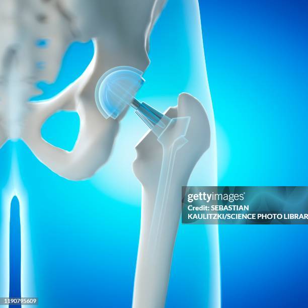 hip replacement, illustration - hip replacement surgery stock illustrations