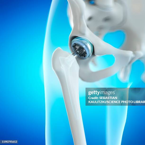 hip replacement, illustration - hip replacement stock illustrations