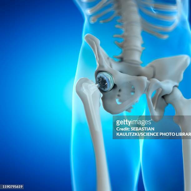 ilustrações, clipart, desenhos animados e ícones de hip replacement, illustration - bacia artificial