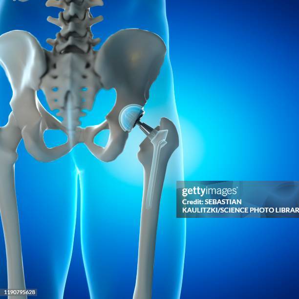 hip replacement, illustration - künstliches hüftgelenk stock-grafiken, -clipart, -cartoons und -symbole