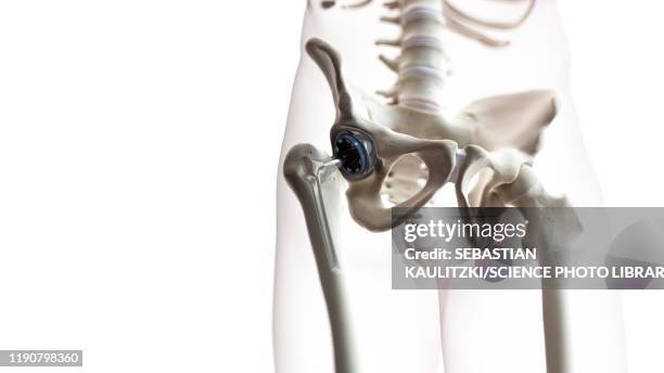 hip replacement, illustration - hip replacement stock illustrations