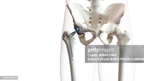hip replacement, illustration - hip replacement stock illustrations