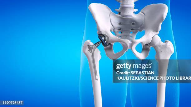 hip replacement, illustration - hip replacement surgery stock illustrations