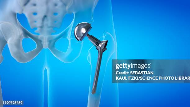 hip replacement, illustration - künstliches hüftgelenk stock-grafiken, -clipart, -cartoons und -symbole