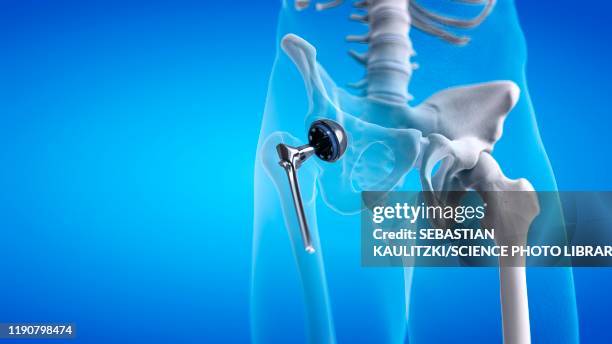 hip replacement, illustration - implant stock illustrations