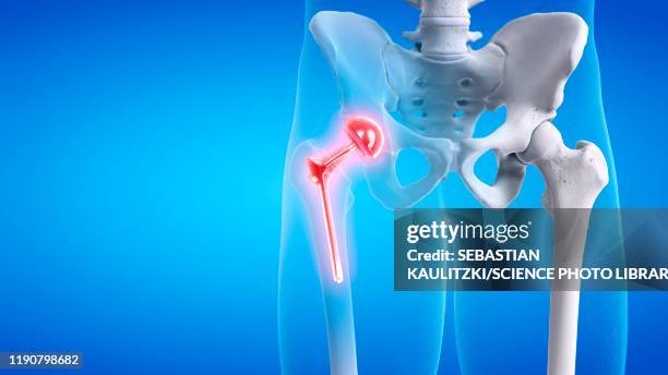 painful hip replacement, conceptual illustration - künstliches hüftgelenk stock-grafiken, -clipart, -cartoons und -symbole