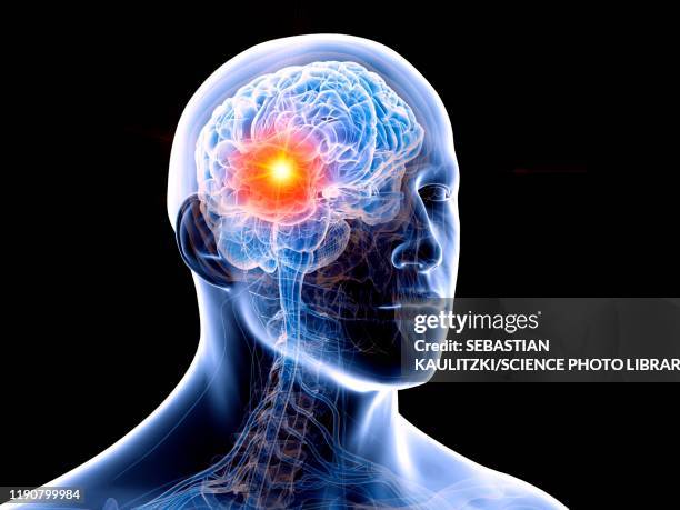 illustrazioni stock, clip art, cartoni animati e icone di tendenza di human brain tumour, illustration - cancro tumore