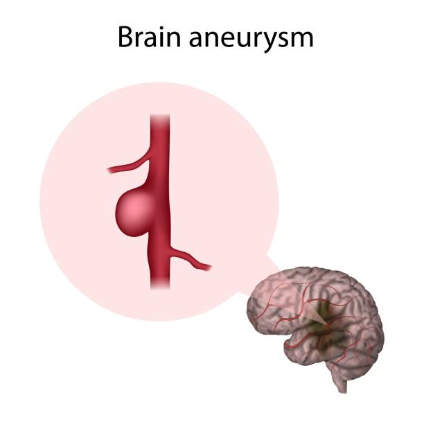 14.494 Brain Aneurysm Doctor High Res Illustrations - Getty Images