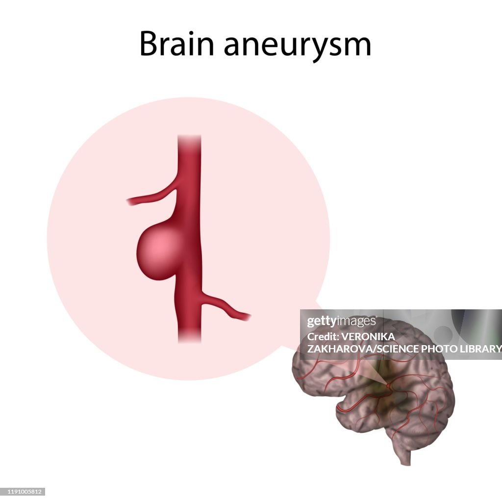 Cerebral Aneurysm