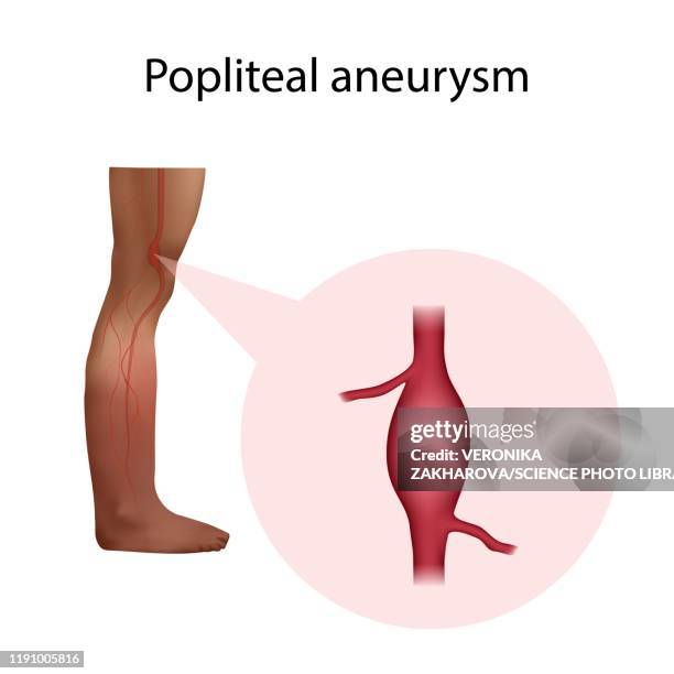 popliteal aneurysm, illustration - aneurysm stock illustrations