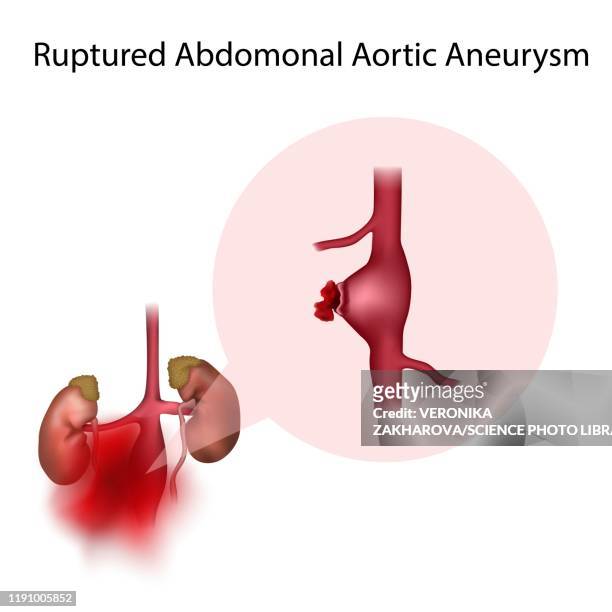 ruptured abdominal aortic aneurysm, illustration - aneurysm stock pictures, royalty-free photos & images
