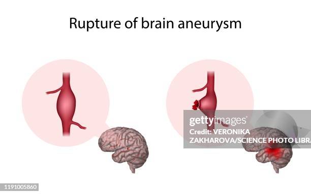 ruptured brain aneurysm, illustration - aneurysm stock-fotos und bilder