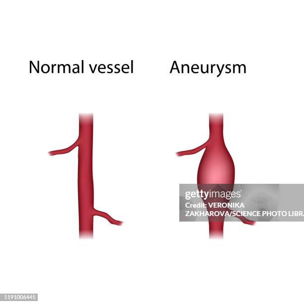 normal vessel and aneurysm, illustration - aortic aneurysm stock illustrations