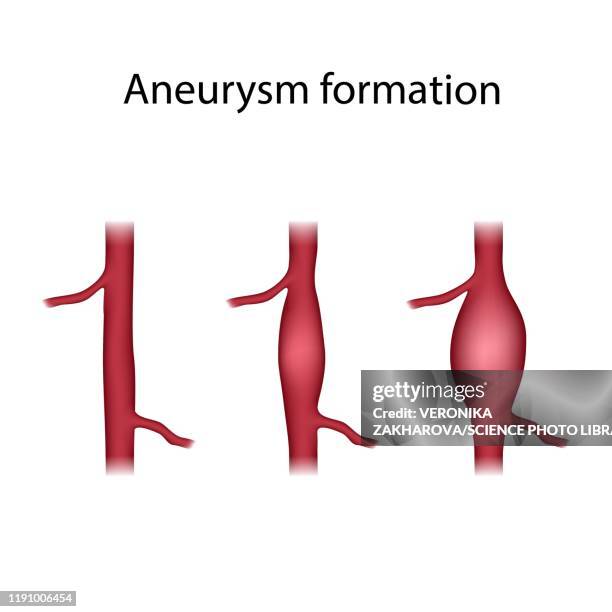 aneurysm formation, illustration - aorta stock illustrations