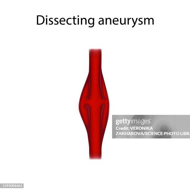 dissecting aneurysm, illustration - artery dissection stock illustrations