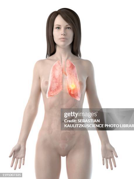 stockillustraties, clipart, cartoons en iconen met lung cancer, conceptual computer illustration - menselijke luchtpijp