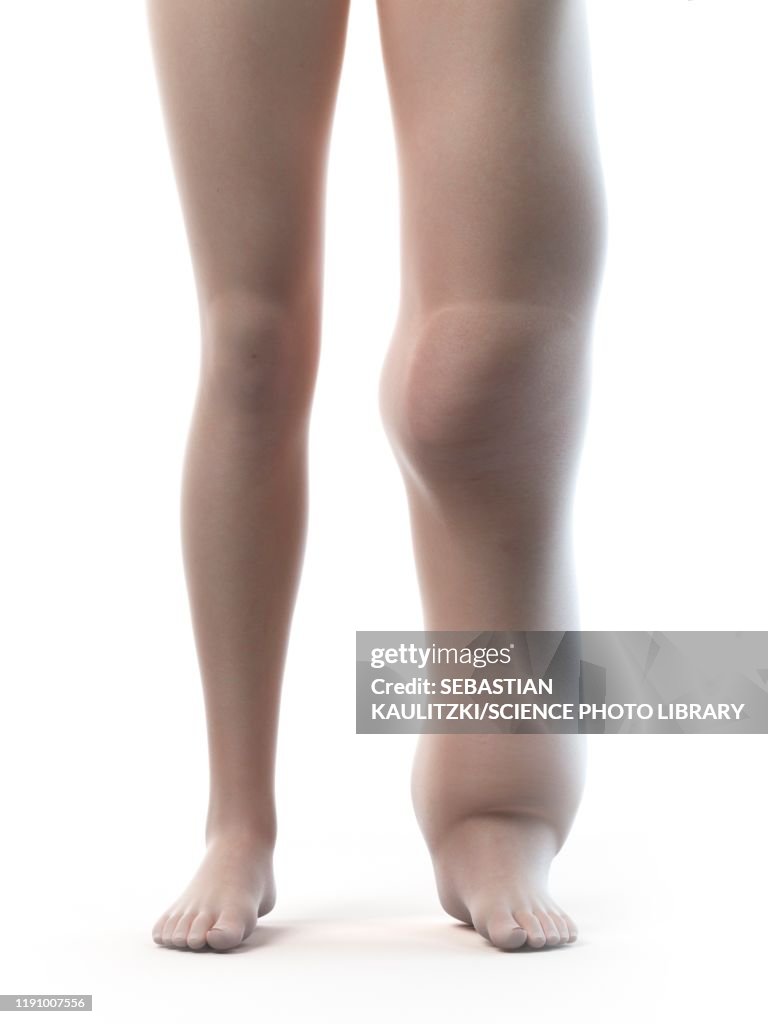 Lymphoedema, illustration