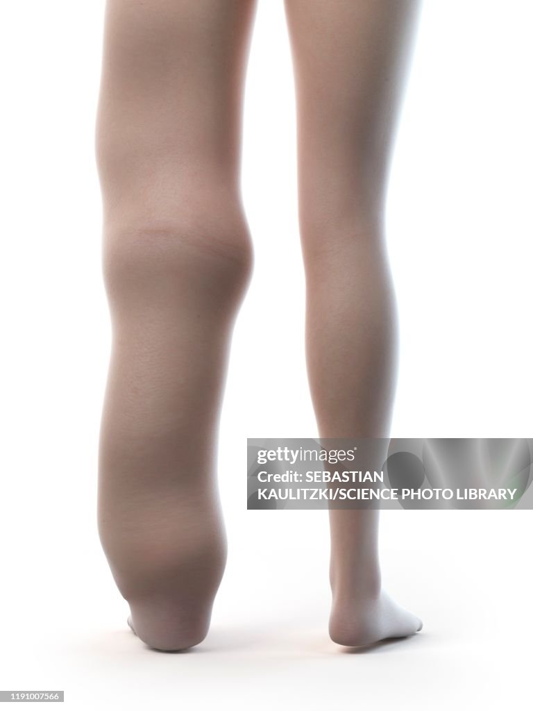 Lymphoedema, illustration