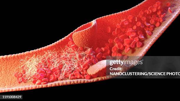 blood clot inside a vein, illustration - blutgerinnsel stock-grafiken, -clipart, -cartoons und -symbole