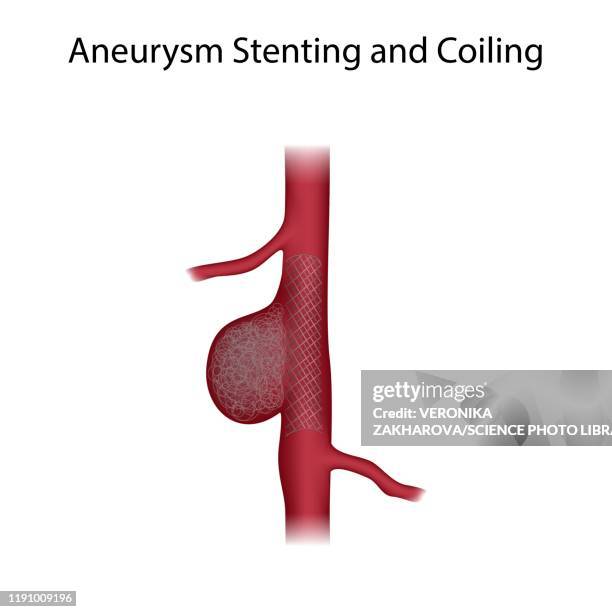 Stent Artery Photos and Premium High Res Pictures - Getty Images