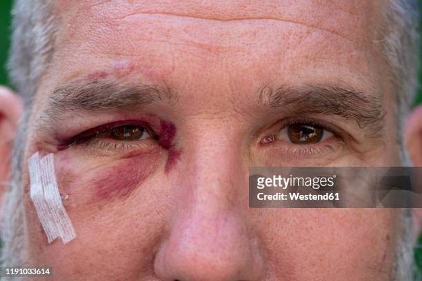 close-up of man with black eye - olho preto - fotografias e filmes do acervo