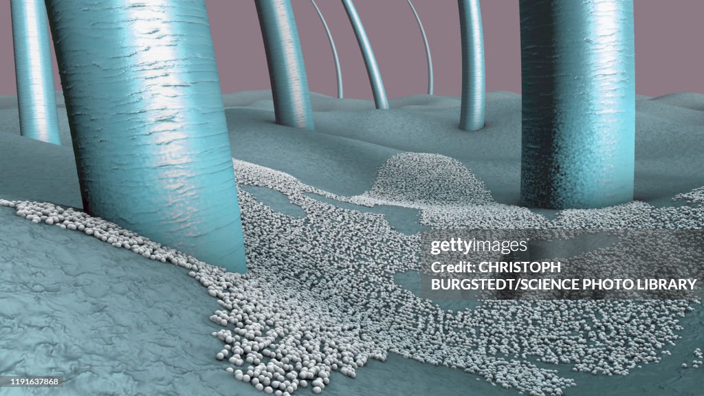 Fungal skin infection, illustration