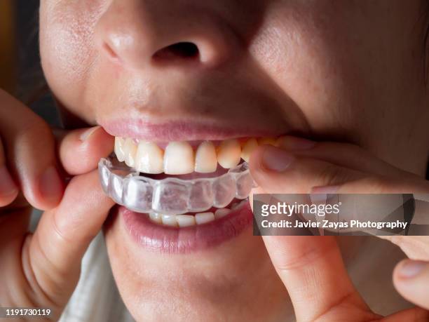 close-up of young woman wearing clear invisible orthodontics - invisalign stock pictures, royalty-free photos & images