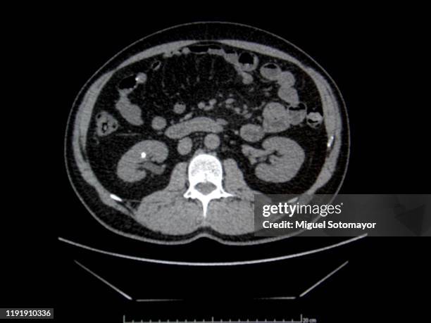 Lithiasis 199 Renal Calculi Stock Photos, High-Res Pictures, and Images - Getty ...
