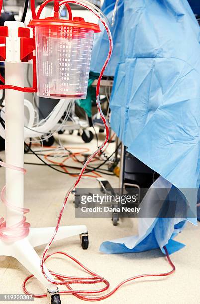 blood flowing into suction canister during surgery - tubo de succión fotografías e imágenes de stock