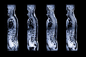 MRI of whole spine