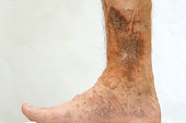 Human skin disease. Person s foot that is affected by dermatological skin disease with scars, ulcers and pigment spots. Perhaps this is varicose veins on the leg.