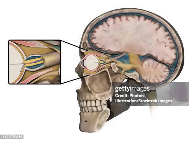 medical concept shows swelling of the optic nerve caused by increased intracranial pressure. - papilledema stock illustrations