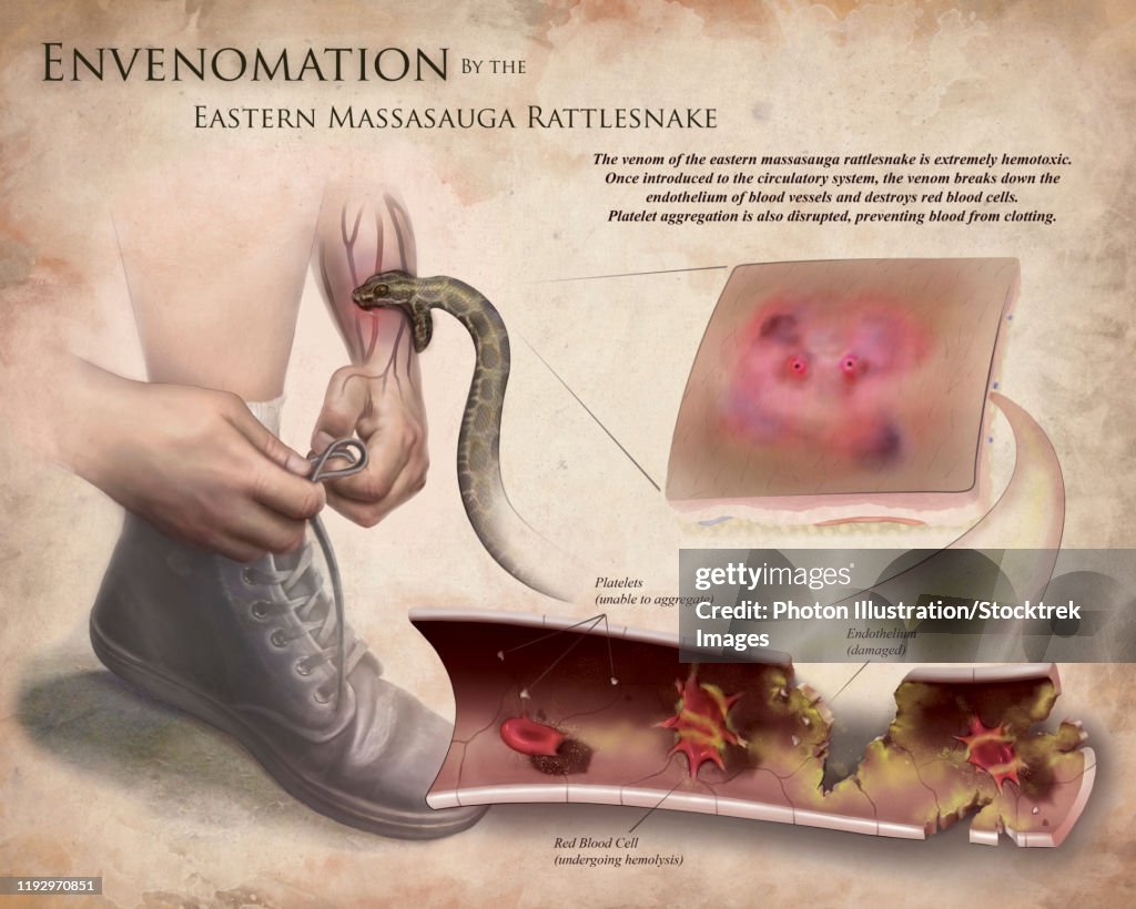 Medical illustration depicting the effects of envenomation by the eastern massasauga rattlesnake.