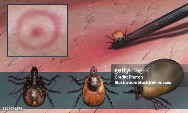 ilustrações, clipart, desenhos animados e ícones de illustration showing a deer tick bite and its removal. - insect bites images