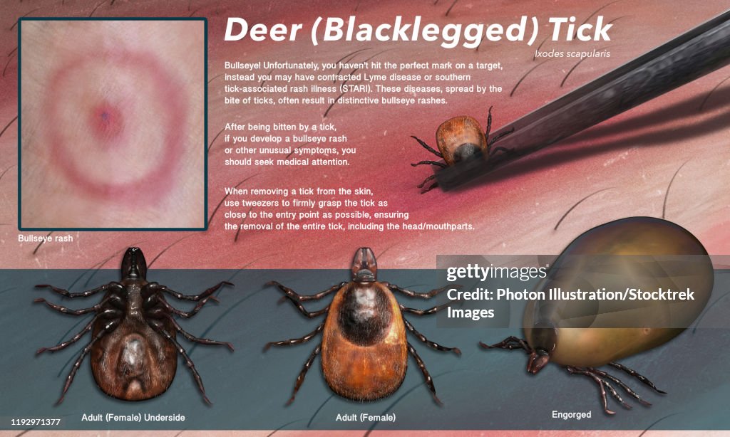 Illustration showing a deer tick bite and its removal.