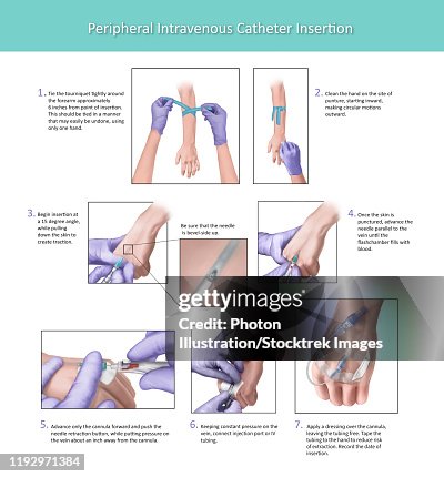 Iv Insertion Steps Illustration Depicting The Proper Placement Of A Peripheral Intravenous ...