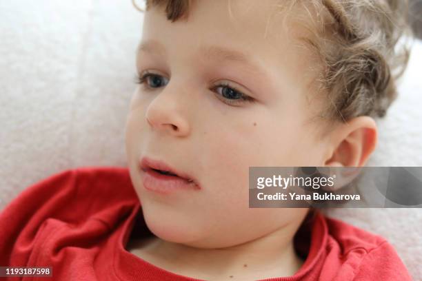 dry and cracked lips of a little boy - cold sore stock-fotos und bilder