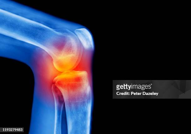 x-ray of human knee, sports injury, showing pain - knee replacement surgery - fotografias e filmes do acervo