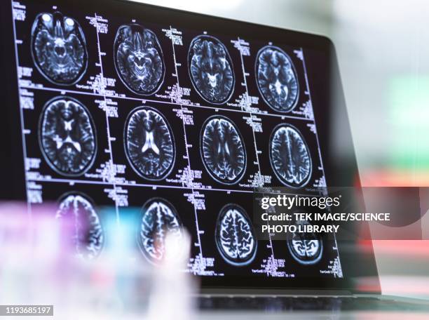 neurology diagnosis - atrophy stock pictures, royalty-free photos & images