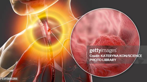 oesophageal cancer, composite illustration - oesophagus stock illustrations