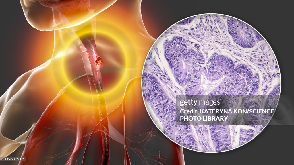 Oesophageal cancer, illustration and micrograph
